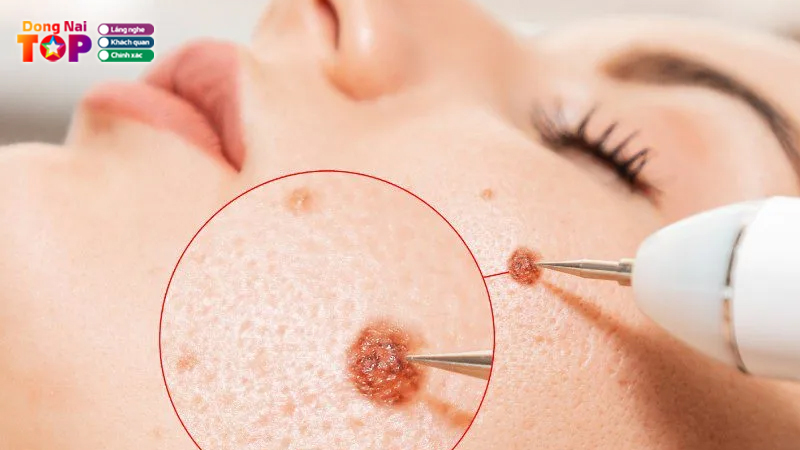 Top-5-dia-chi-xoa-not-ruoi-dong-nai-dep-khong-ti-vet